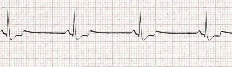 Sinus bradycardia (heart rate less than 60)