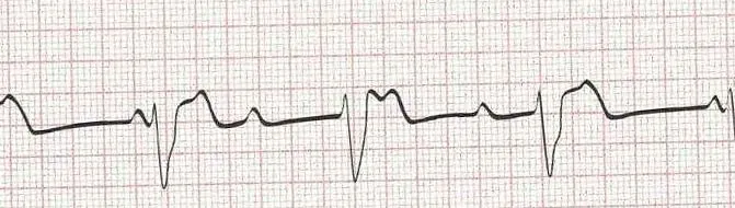 Complete heart block (3rd degree heart block) with ventricular (wide) response