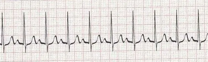 Sinus tachycardia - heart rate greater than 100