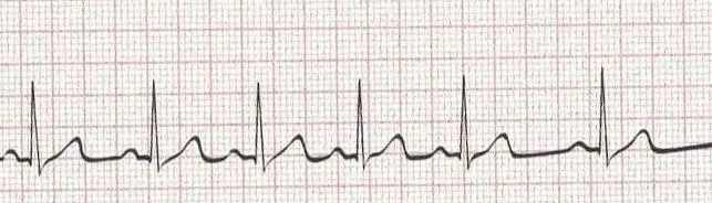 Sinus arrhythmia