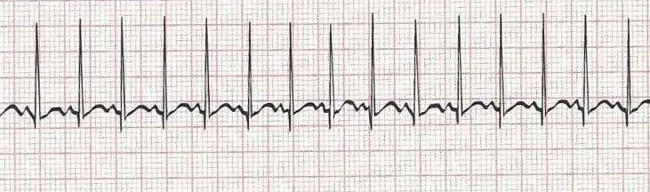 Sinus tachycardia - heart rate greater than 100