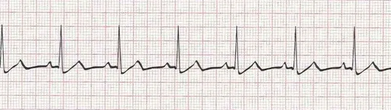 Normal sinus rhythm