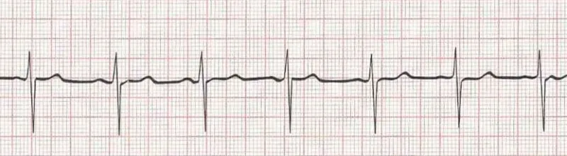 Normal sinus rhythm