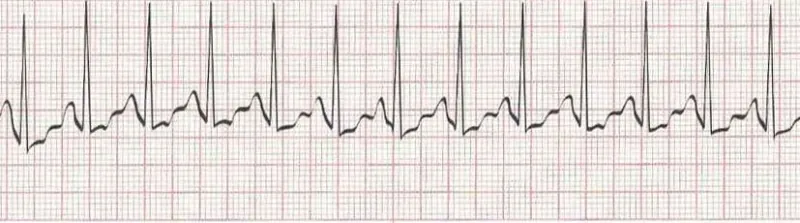 Sinus tachycardia