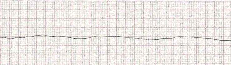 Asystole