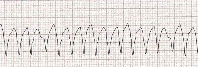 Ventricular tachycardia