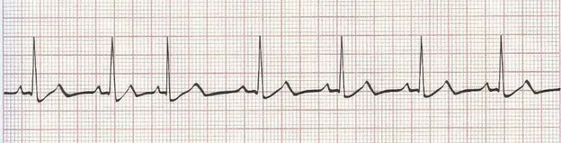 Wandering atrial pacemaker with PAC