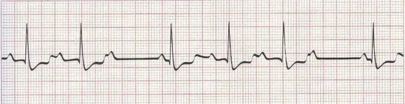 2nd degree AV block mobitz I (wenckebach)  PR gets longer, longer then dropped QRS