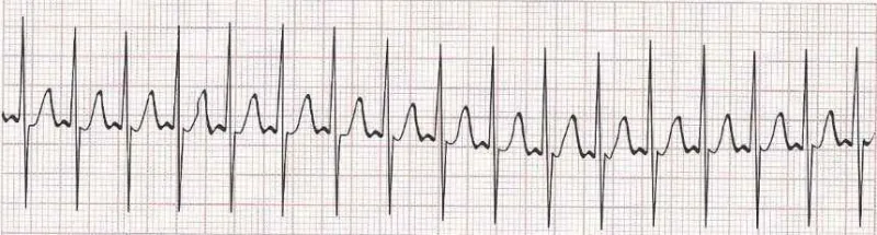 Sinus tachycardia - heart rate greater than 100