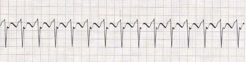 Atrial flutter with 2:1 conduction (would accept SVT)