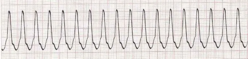Ventricular tachycardia