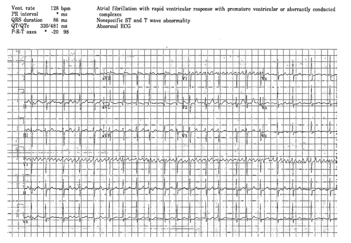 Atrial fibrillation with rapid ventricular response