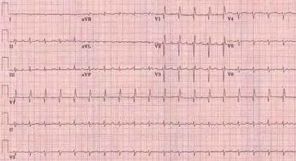 Heart block or not.