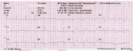 proximal LAD occlusion