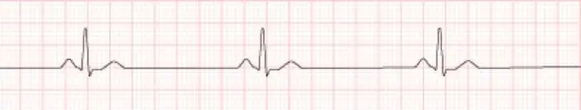 Sinus bradycardia