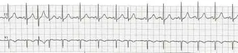 Sinus rhythm with frequent pacs
